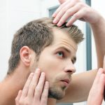 Hair Loss in Bodybuilding – A Complete Guide to Why it happens and How to Treat it